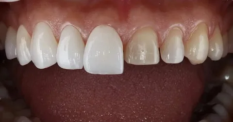 Zirkonyum Kaplama Avantajları