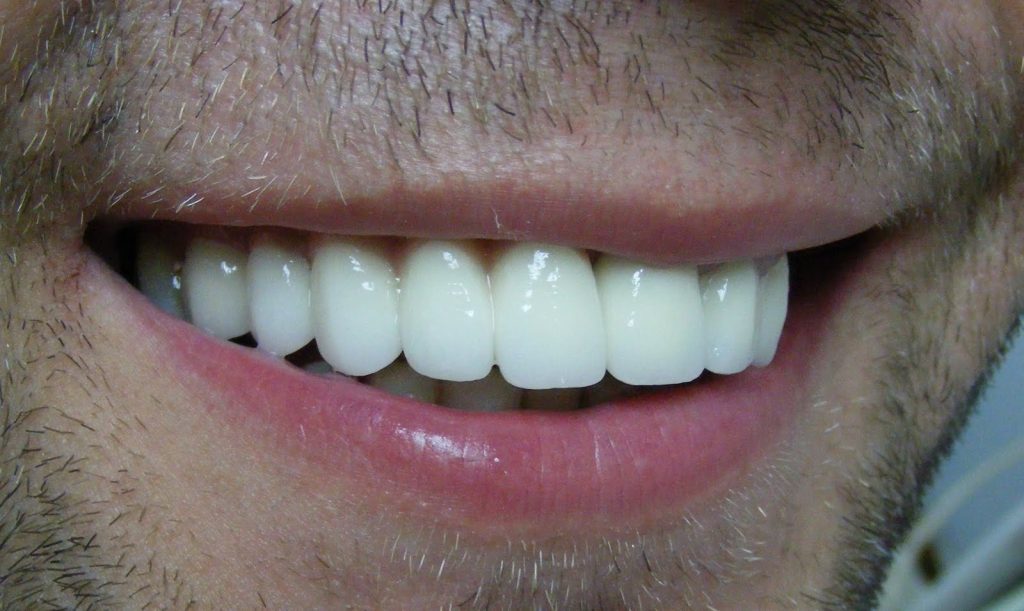 Diş Kaplama Çeşitleri