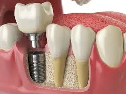 İmplant Diş Hakkında Sıkça Sorulan Sorular