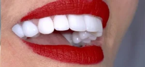 Zirkonyum Kaplama Hakkında Sıkça Sorulan Sorular