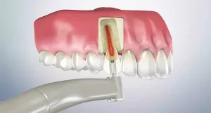 Kanal Tedavisi Nedir