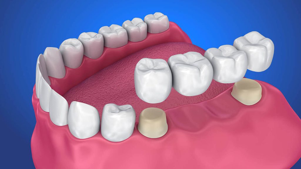 Protez Diş Nasıl Yapılır?
