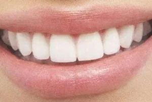 Kaplama Diş Nedir?